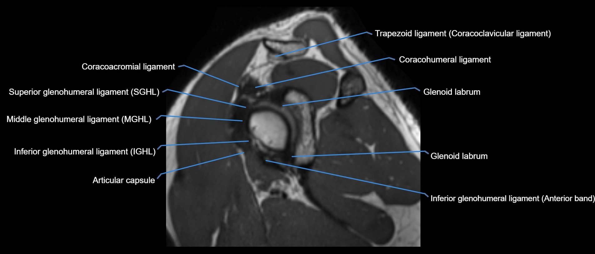 shoulder ligaments sagittal  cross sectional anatomy 3T MRI AI enhanced radiology image -img-00001-00027.webp